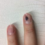 ズキズキ痛い指先の内出血！-爪下血種の原因とすぐに出来る対処法