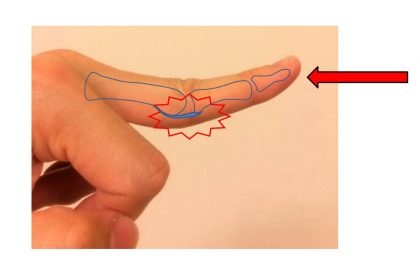 掌側板損傷の図