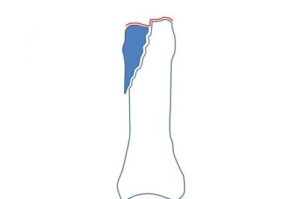 基節骨頭部の骨折の図