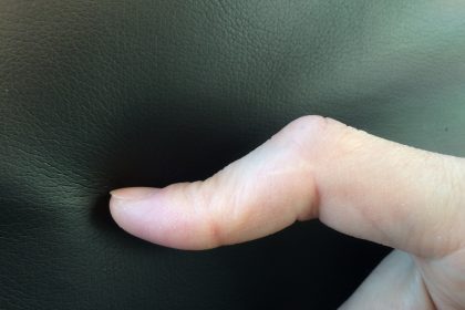 ボタン穴変形の指の写真