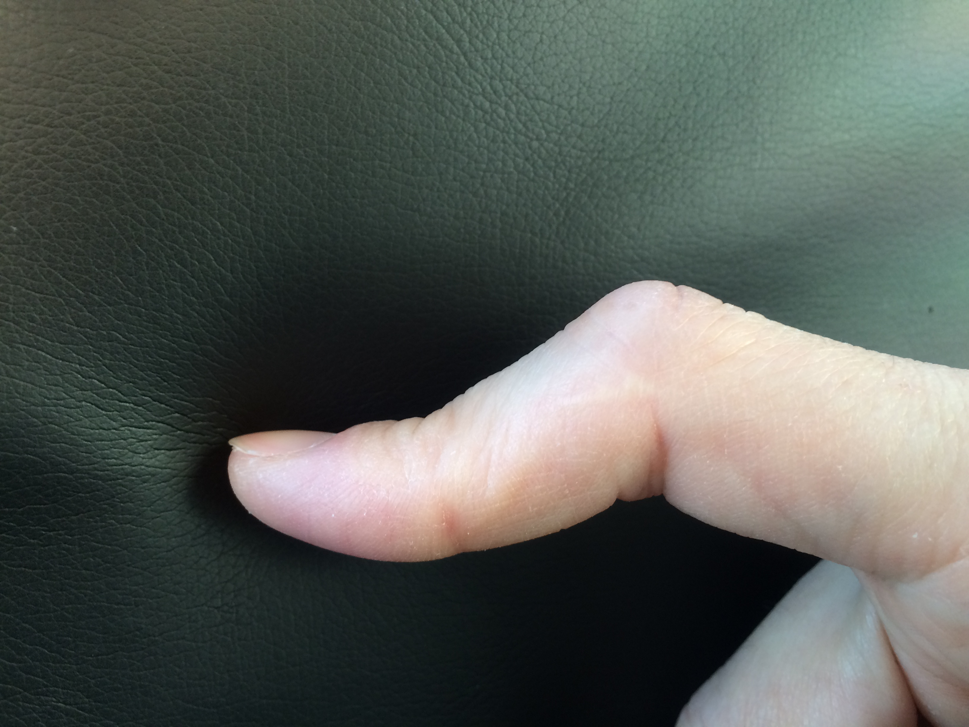 ボタン穴変形の指の写真