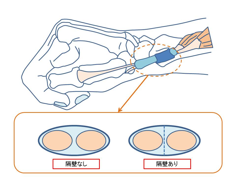 ドケルバン腱鞘炎の解剖図（隔壁）