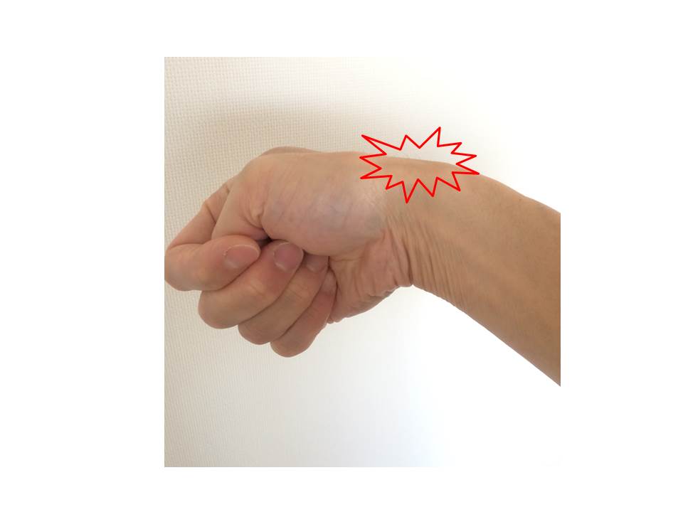 ドケルバン腱鞘炎はどのように治療されますか?