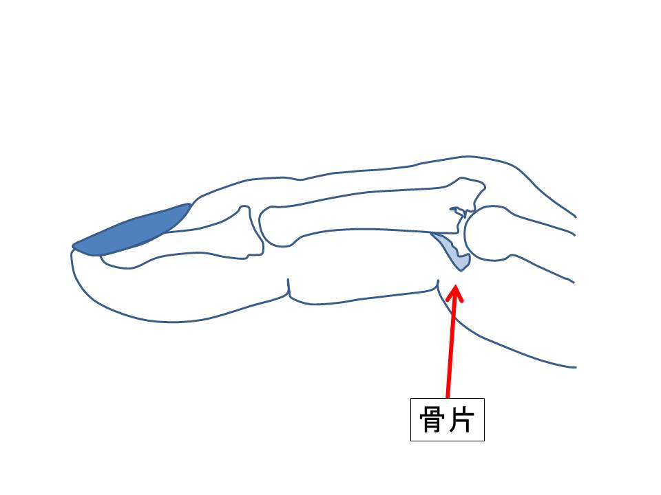 指脱臼の図