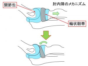 肘内障のメカニズムの図