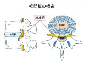 腰椎の形状とヘルニア (3)