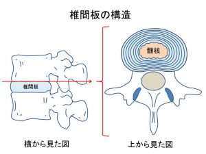 腰椎の形状とヘルニア (2)