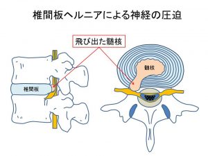 腰椎の形状とヘルニア (6)