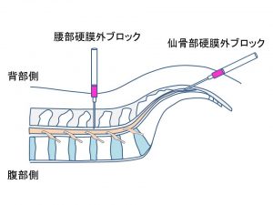 硬膜外ブロック