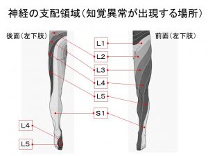 椎間板ヘルニアによる神経障害