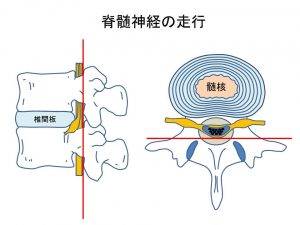椎間板ヘルニアによる神経障害