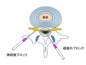 硬膜外ブロックと神経根ブロック