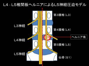 椎間板ヘルニアによる神経障害