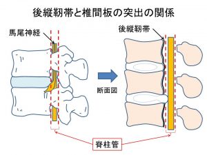 椎間板と後縦靭帯