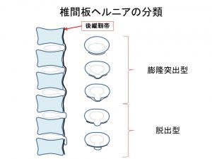 ヘルニアの分類