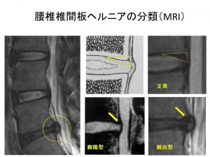 ヘルニアの分類（MRI）