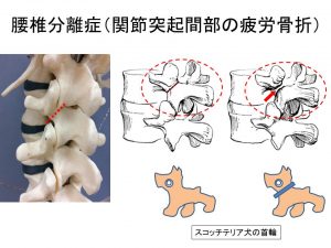 腰椎分離症