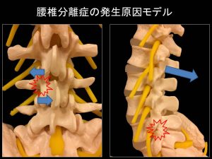 腰椎分離症