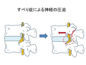 腰椎分離症