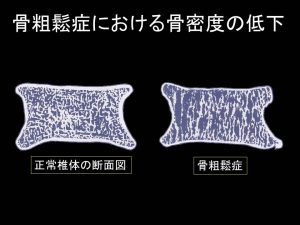 骨粗鬆症における骨密度の低下