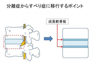 腰椎分離症 