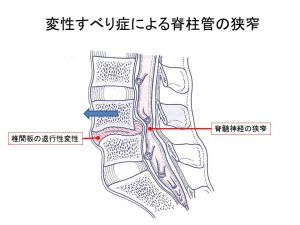 変性すべり症による脊柱管の狭窄