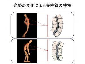 姿勢の変化による脊柱管の狭窄