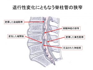 脊柱管の狭窄