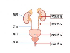 尿管結石