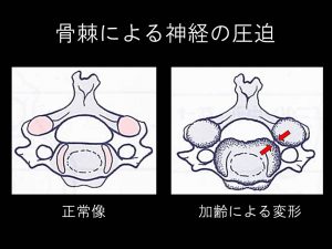 頚椎変形