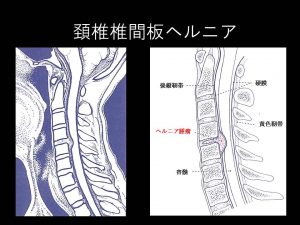 頚椎椎間板ヘルニア（２）