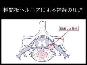 頚椎椎間板ヘルニア