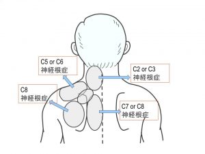 肩こり