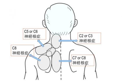 肩こり