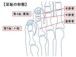 足趾の骨折 (1)