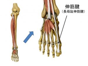 伸筋腱炎 (2)