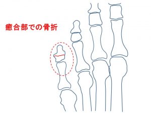 足趾の骨折 (4)