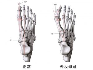 外反母趾 (3)