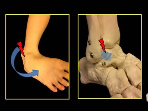 前距腓靭帯損傷