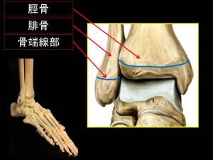 腓骨骨端線損傷 (2)