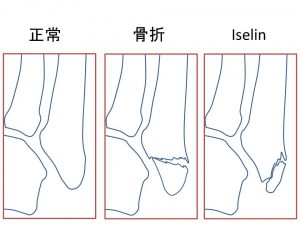 Iselin 第五中足骨骨折 (4)