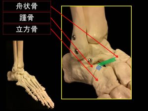 二分靭帯損傷 (4)