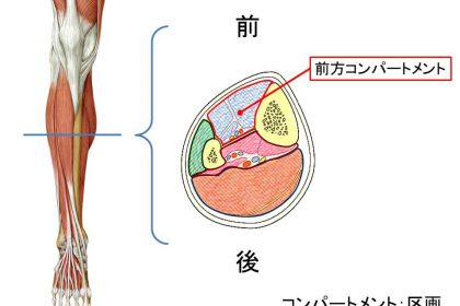 コンパートメント症候群 (2)