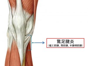 鵞足腱炎（２）