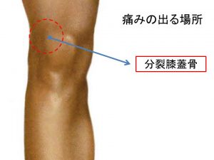 分裂膝蓋骨 (2)