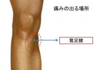 鵞足腱炎