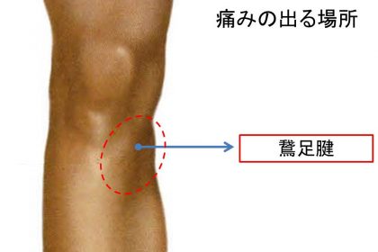 鵞足腱炎