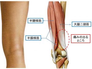 大腿二頭筋短絡