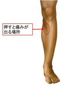 ２膝窩筋炎