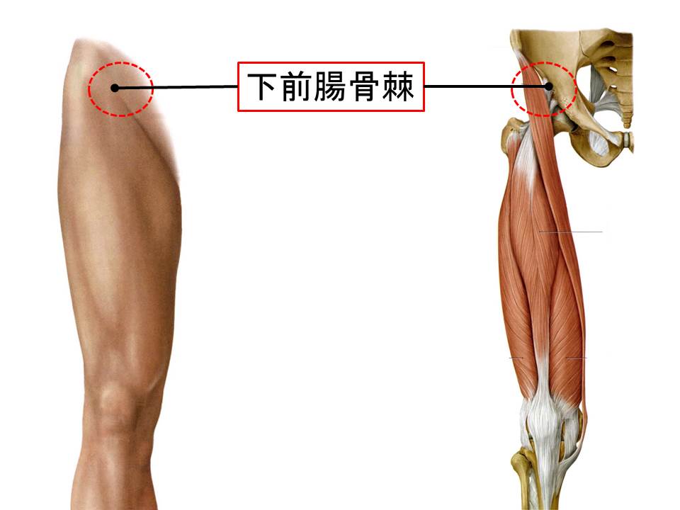 下前腸骨棘の裂離骨折 (1)